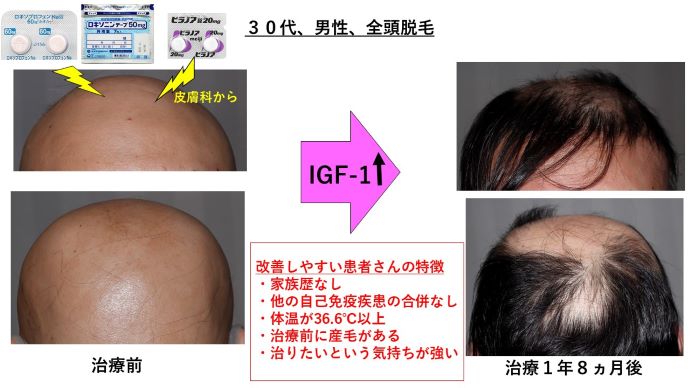 円形脱毛症　病院